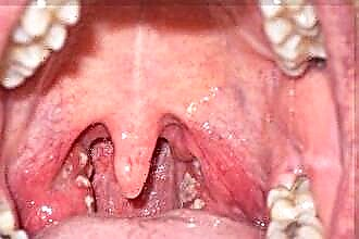 Les causes de la laryngite
