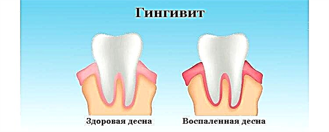 كيفية علاج التهاب الحنجرة المزمن