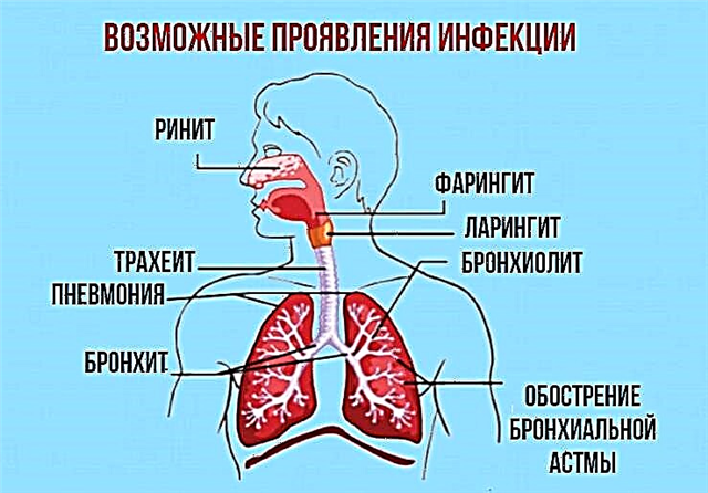 Фарингит бронхит. Фарингит, инфекции верхних дыхательных путей*. Заболевания органов дыхания трахеит.