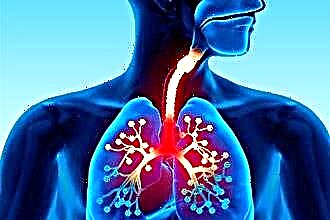 Kuinka erottaa trakeiitti keuhkoputkentulehduksesta