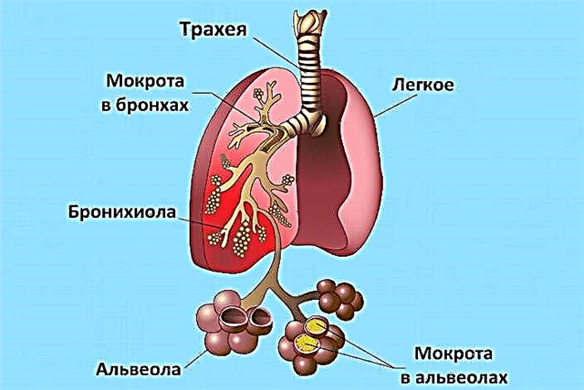 Трахейний кашель та його лікування