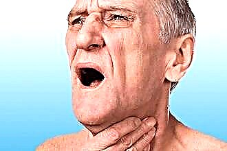 Signes d'inflammation et traitements de l'amygdale linguale
