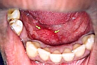 Come trattare l'infiammazione della tonsilla linguale