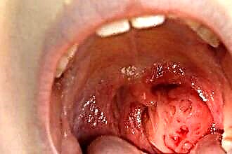 Reasons for an increase in tonsils in a child