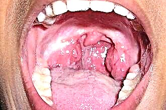 Symptomen en behandeling van laryngotracheïtis bij een kind