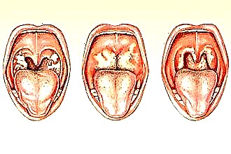 Symptoms and treatment of diseases of the larynx