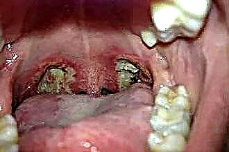 口蓋扁桃の良性および悪性疾患