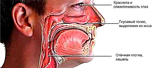 Hvordan man helbreder rhinopharyngitis