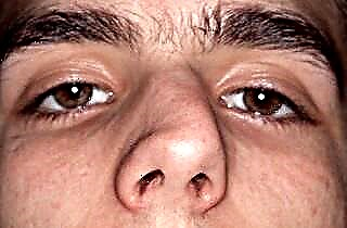 Penyebab dan pengobatan pembengkakan mukosa hidung