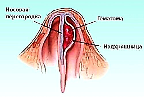 Por que ocorre um hematoma do septo nasal e como eliminá-lo?