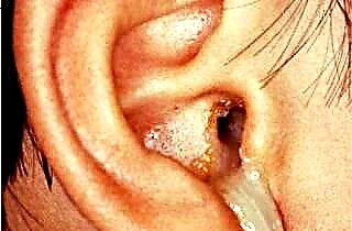 أفضل المضادات الحيوية لآلام الأذن