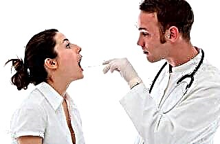 Come trattare la tonsillite