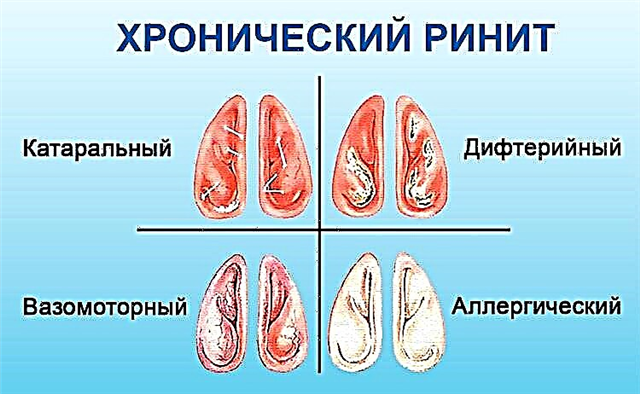 Слизистая носа вазомоторный ринит. Хронический вазомоторный ринит. Хронический гипертрофический ринит. Вазомоторный гипертрофический ринит.