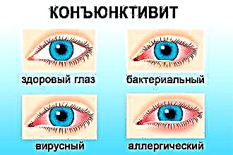 Τι να κάνετε εάν έχετε καταρροή και υγρά μάτια
