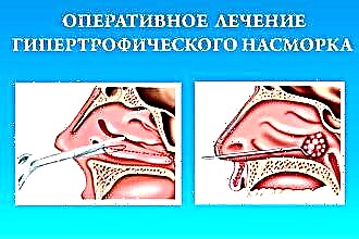 Metode zdravljenja kroničnega hipertrofičnega rinitisa