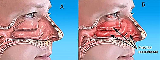 Причини болю всередині носа при натисканні