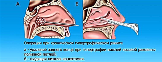 Vzroki za trajno zamašen nos