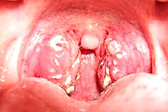 Why does white plaque appear on the tonsils in children