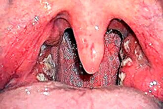 As causas e tratamento de feridas na garganta