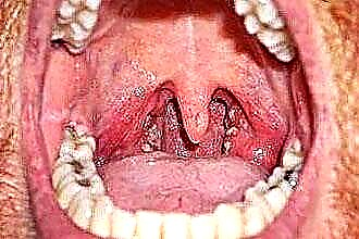 What do loose tonsils mean?