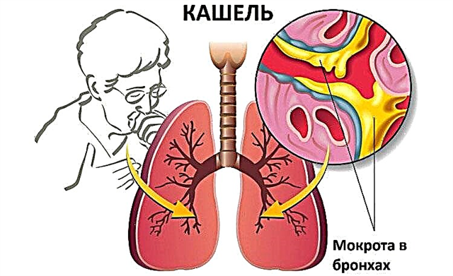 Brown sputum when coughing
