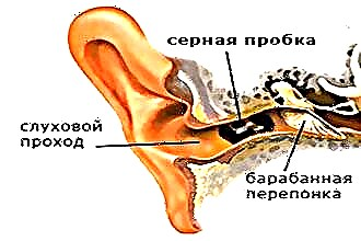Слуховой проход серная пробка. Наружный слуховой проход серная пробка. Серная пробка в ухе перекись водорода. Строение уха человека серная пробка.