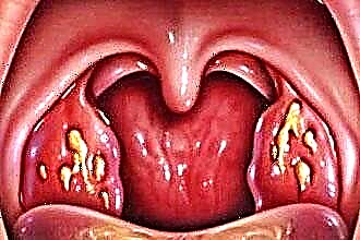 Gurgla med kronisk tonsillit