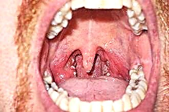 Hoe een keel met laryngitis te verzachten?