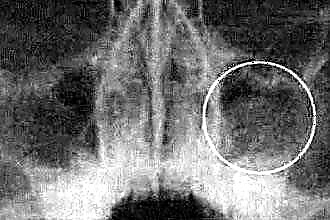 MRI of the sinuses
