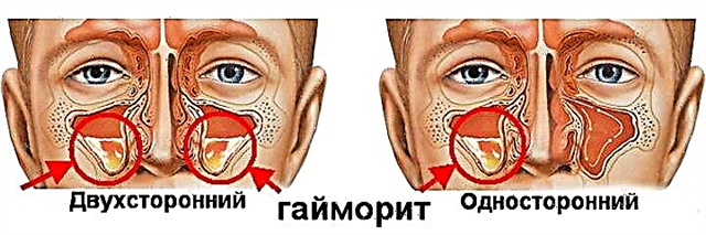 Apakah itu sinusitis maxillary (sinusitis)