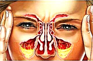 Ko se sinusitis zgodi brez izcedek iz nosu