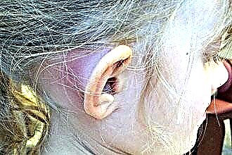 Ropne zapalenie ucha środkowego u dzieci