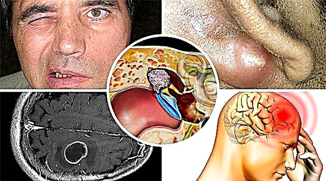 لماذا يعتبر التهاب الأذن الوسطى خطيرًا: العواقب والمضاعفات