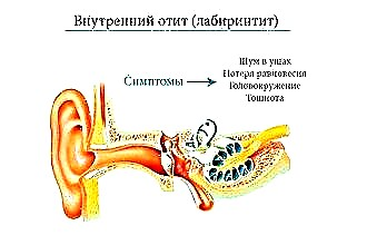 Orta kulak iltihabına ne sebep olur - iltihaplanma nedenleri