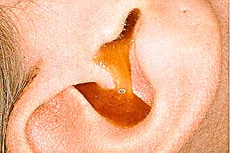 Simptomi in znaki vnetja srednjega ušesa - kako ga opredeliti