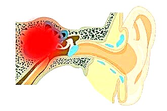 Razvrstitev in vrste vnetja srednjega ušesa
